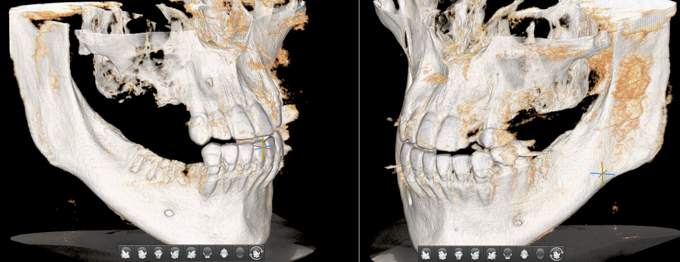 Tooth extraction, “inexpensive”... consequences - My, Dentist, Dentistry, Surgeon, Doctors, Teeth, Dental implantation, The medicine, Doctor, Longpost, Extraction of teeth