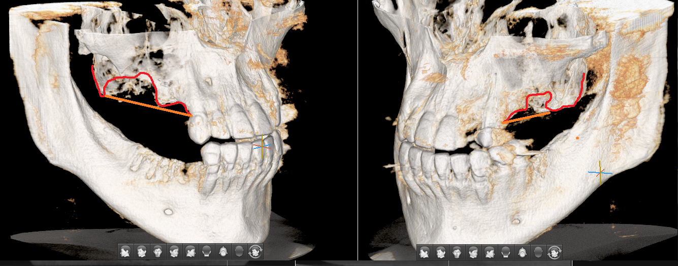 Tooth extraction, “inexpensive”... consequences - My, Dentist, Dentistry, Surgeon, Doctors, Teeth, Dental implantation, The medicine, Doctor, Longpost, Extraction of teeth