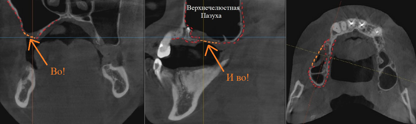 Tooth extraction, “inexpensive”... consequences - My, Dentist, Dentistry, Surgeon, Doctors, Teeth, Dental implantation, The medicine, Doctor, Longpost, Extraction of teeth