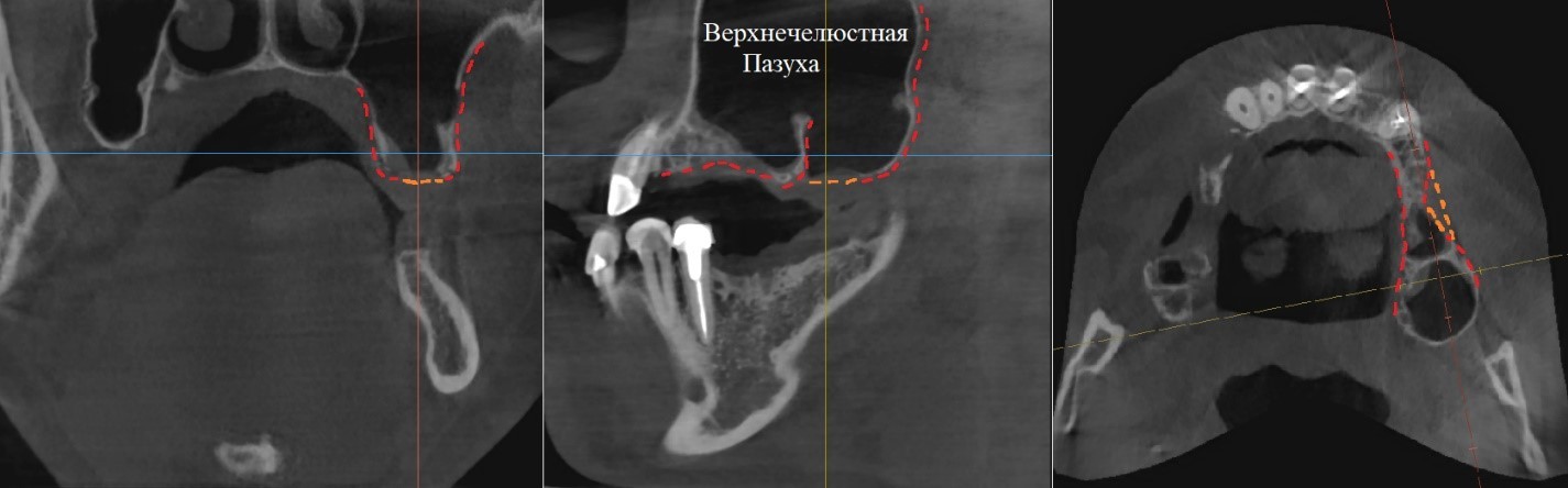 Tooth extraction, “inexpensive”... consequences - My, Dentist, Dentistry, Surgeon, Doctors, Teeth, Dental implantation, The medicine, Doctor, Longpost, Extraction of teeth