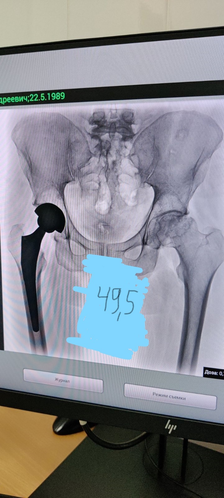 Leukemia, necrosis, fucking pump, or what happened next? - My, Cancer and oncology, Necrosis, Mat, Disease, Joints, Longpost