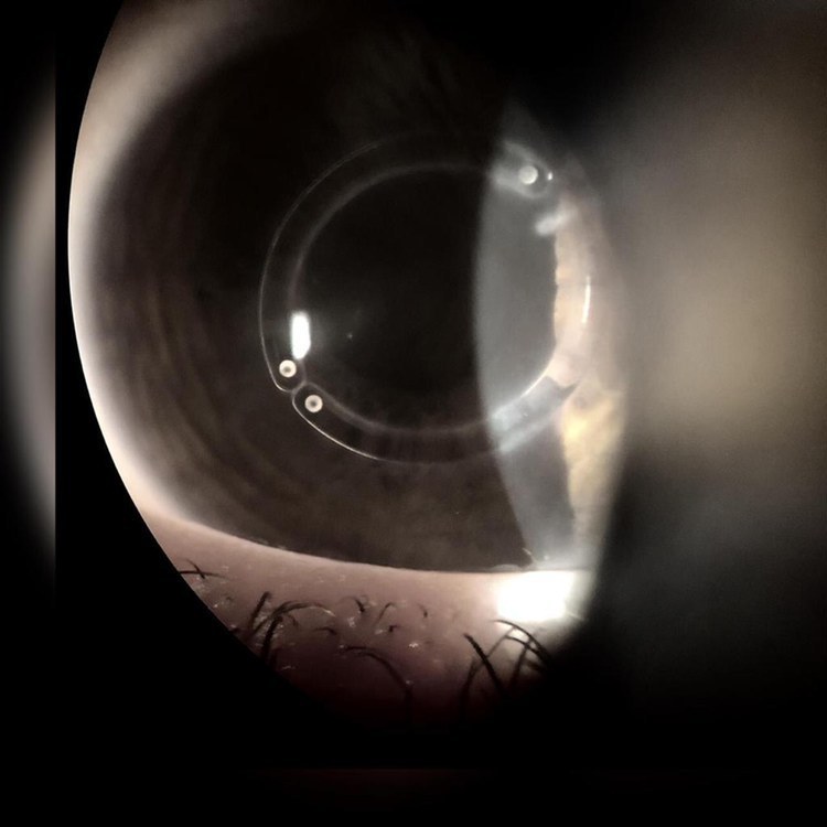 Or maybe a ring in the eye? - My, Poor eyesight, operating room, Health, Video, Longpost