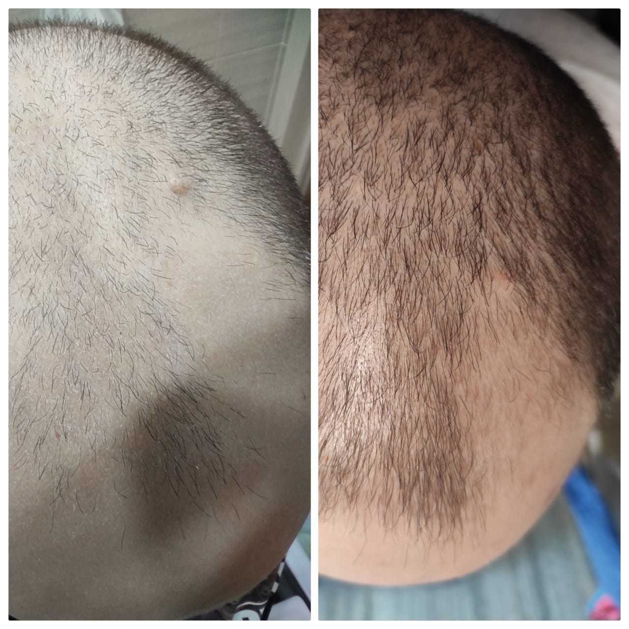 We treat baldness! 32 years. result in 2.5 months - My, Bald head, Treatment, Medications, Allopecia, Longpost, Minoxidil, Recommendations