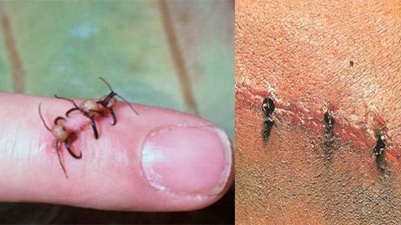 Ant stitch - Wound, A cut, First aid, Jungle, Ants