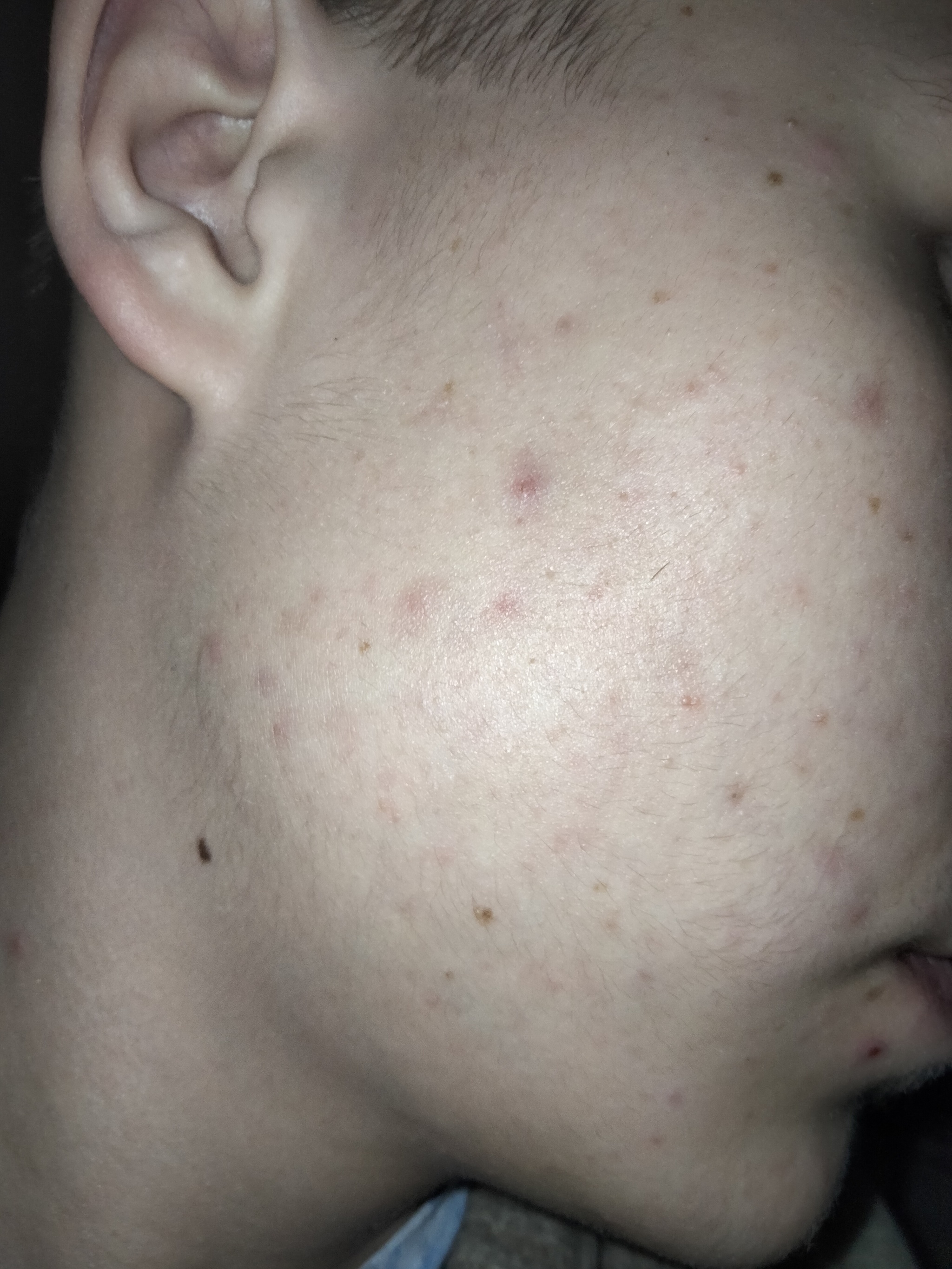 How to get rid of acne? - NSFW, Acne, Deception, Longpost