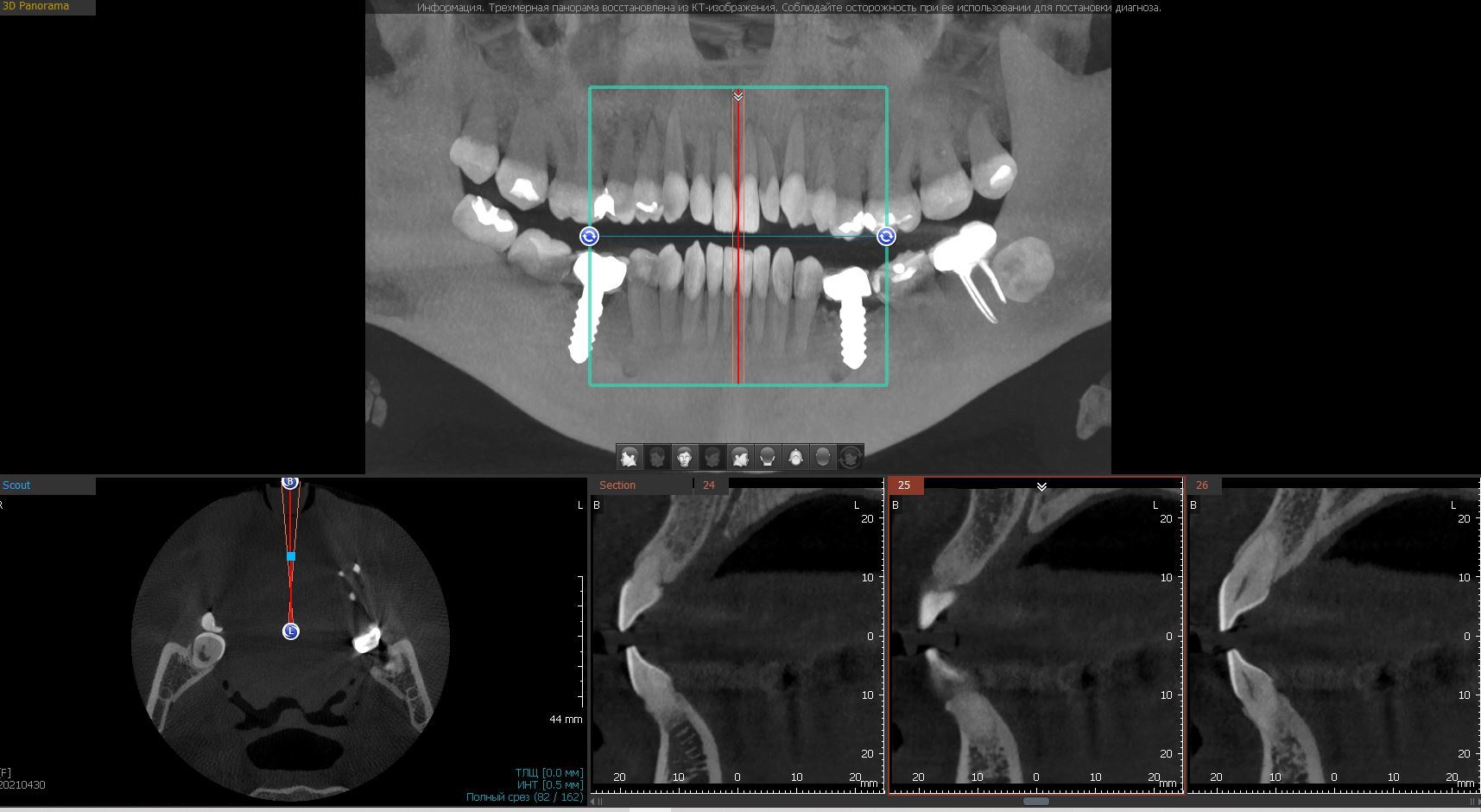 SOS!!! Who in Voronezh will be able to screw in a Russian-made Nord Med implant? - My, No rating, Dental implantation, Text, Dentistry