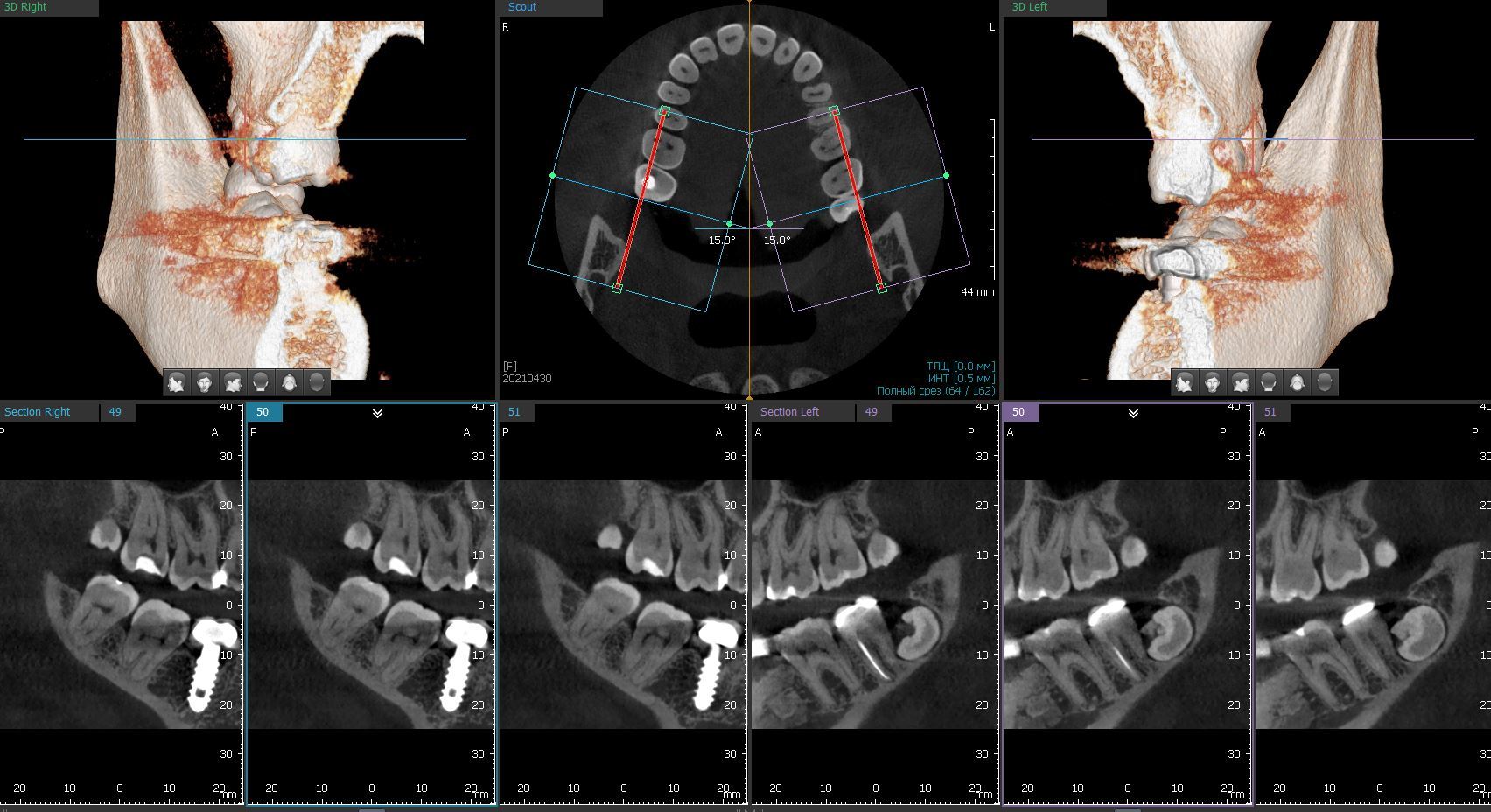 SOS!!! Who in Voronezh will be able to screw in a Russian-made Nord Med implant? - My, No rating, Dental implantation, Text, Dentistry