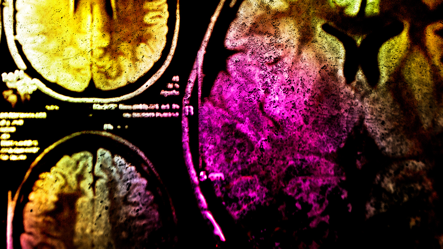 Created a neuroprosthesis that transforms thoughts into printed text - Prosthesis, Brain, Neurophysiology