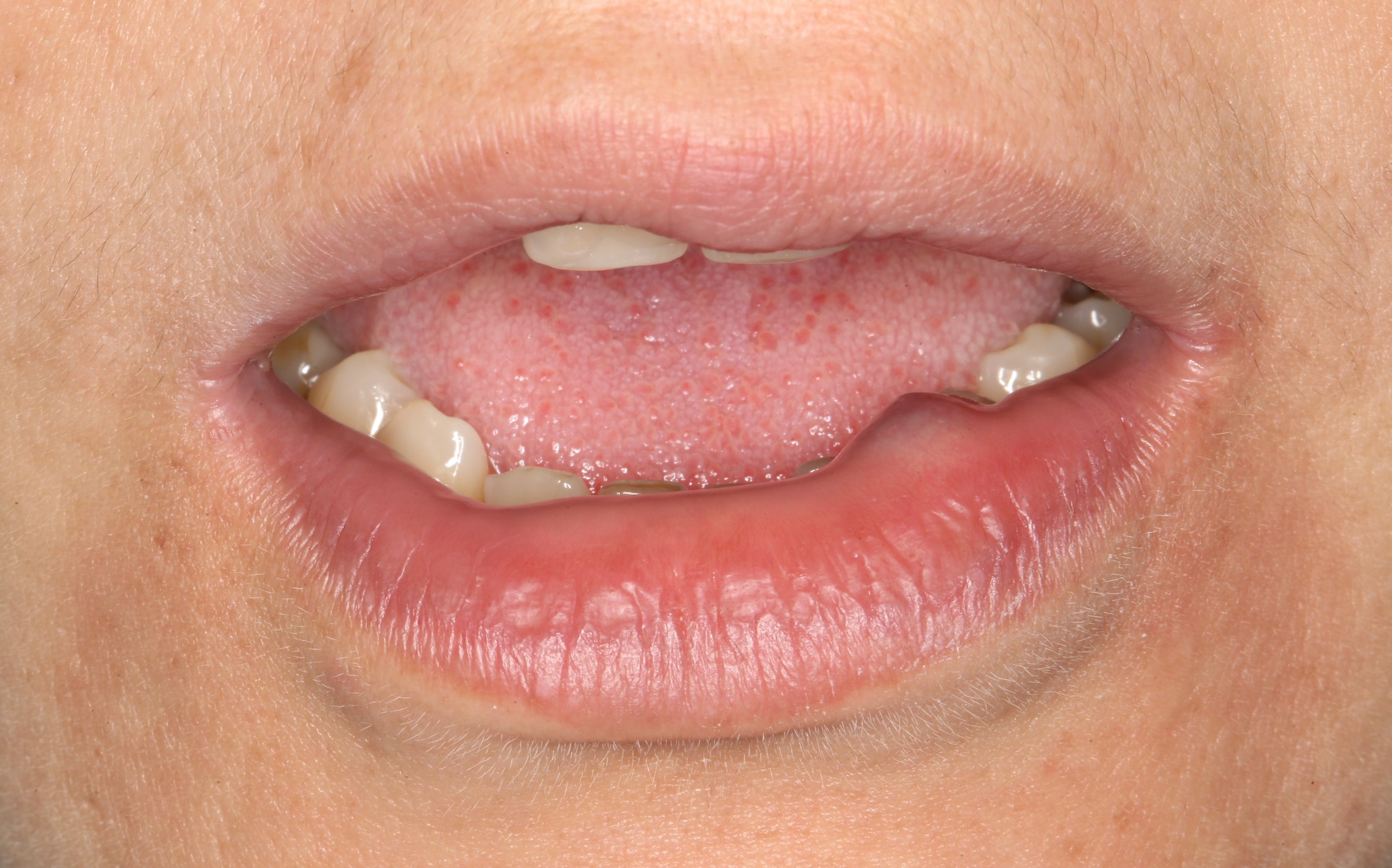 Боль после удаления зуба: сколько болит и как снять?