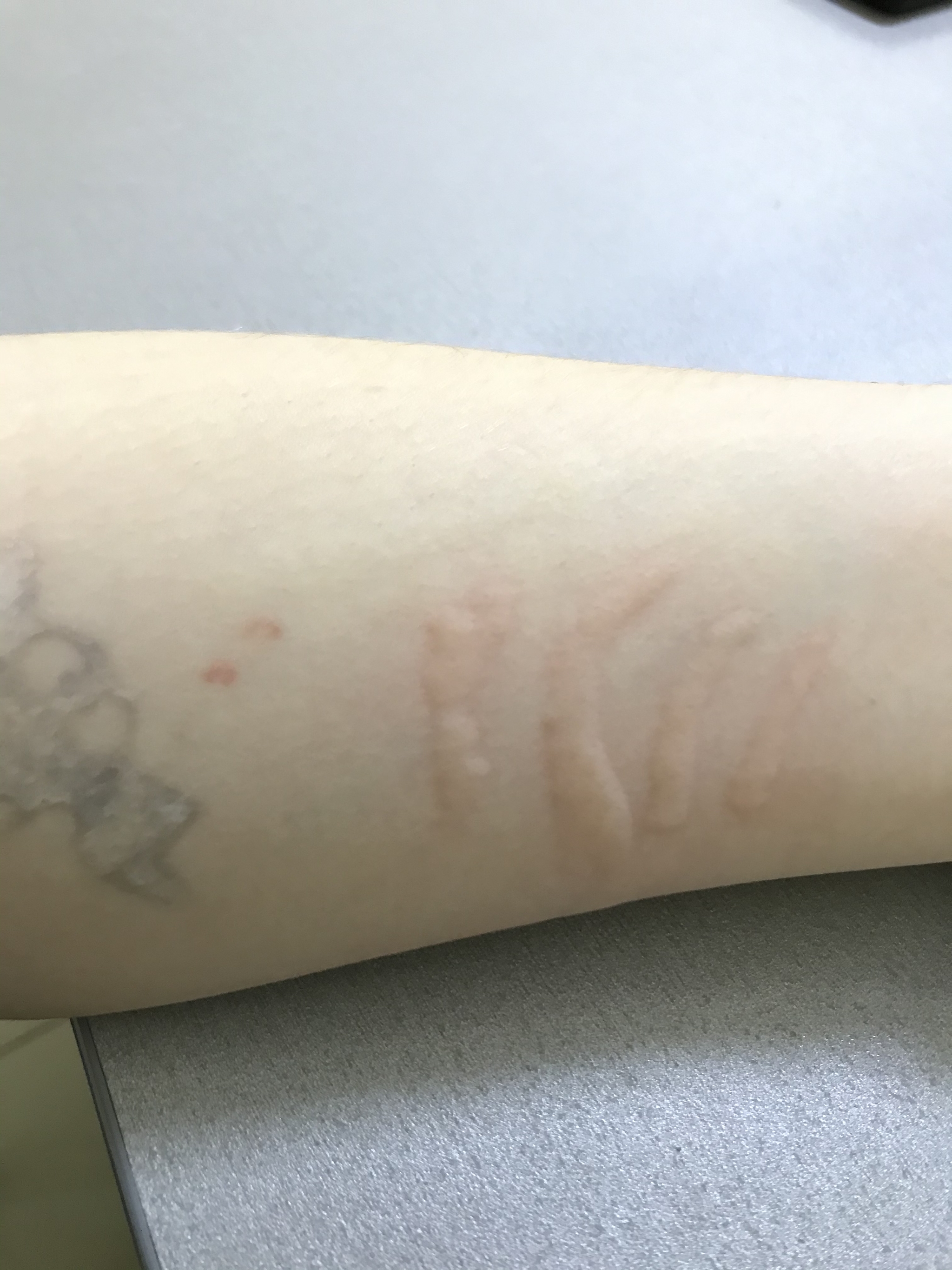 Дермографизм | Пикабу