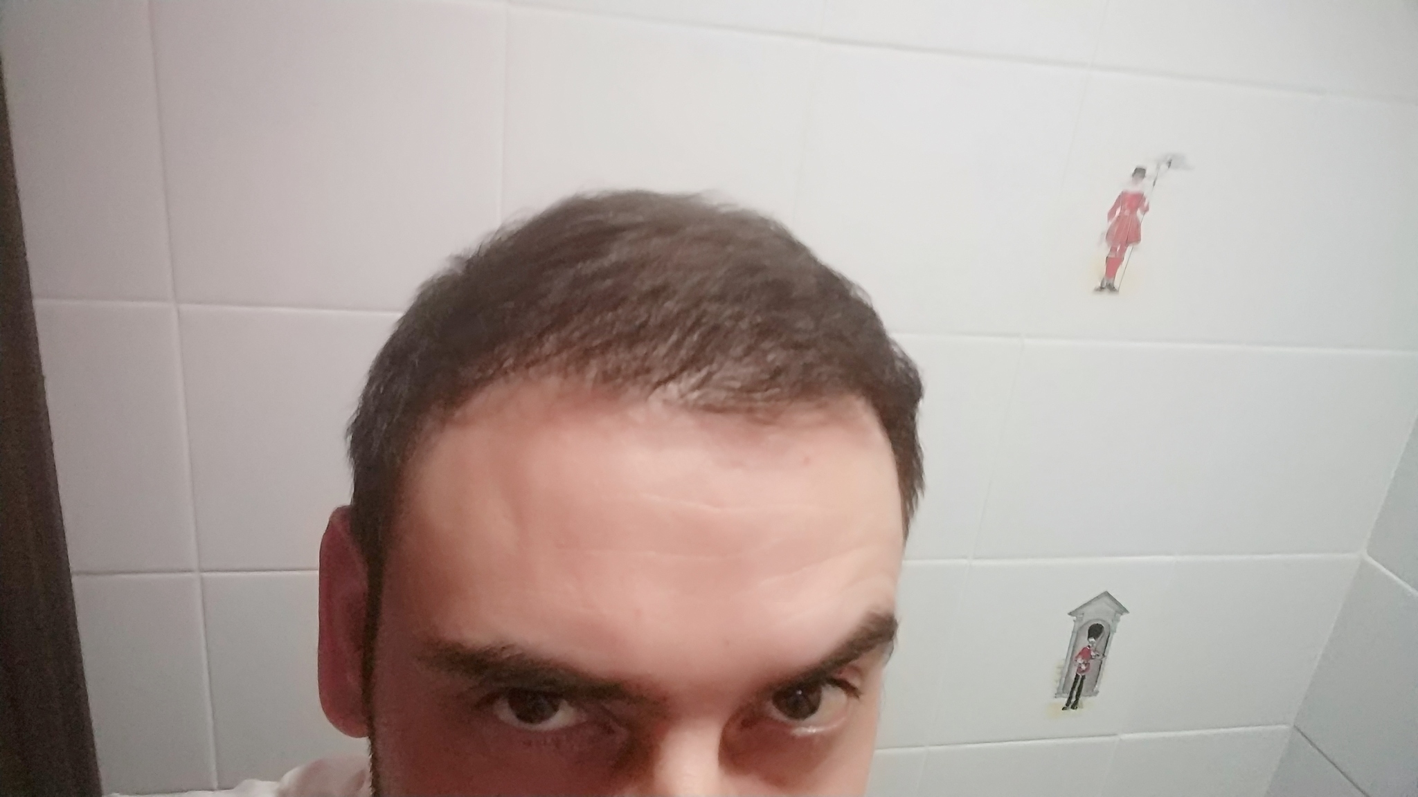 hair from here to there - My, Hair, Transfer, Istanbul, Longpost, Baldness, Hair Transplant