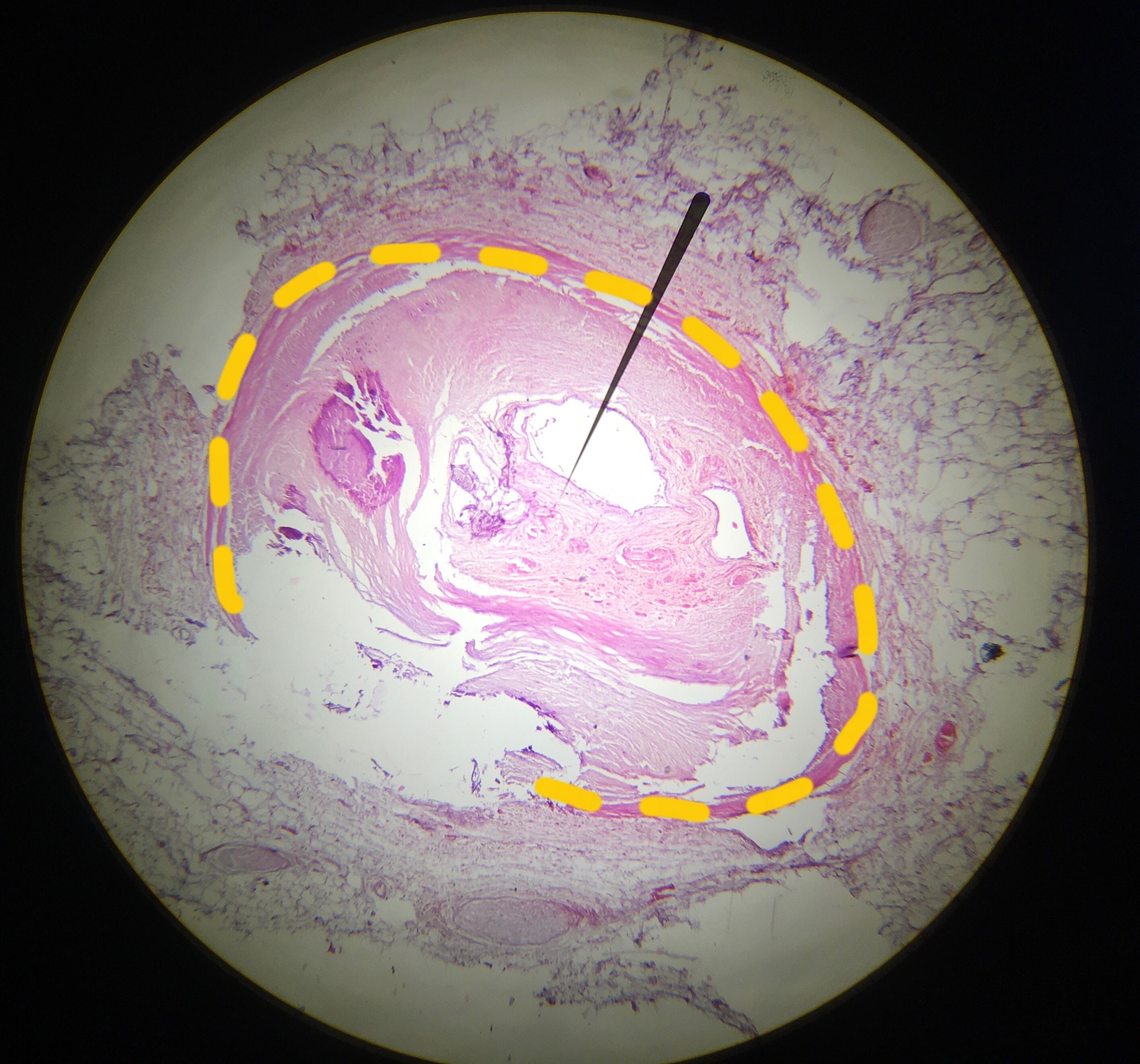 The vessel of the heart that won't say thank you to you - My, Atherosclerosis, Forensic examination, Histology, Healthy lifestyle, Dead body, The medicine