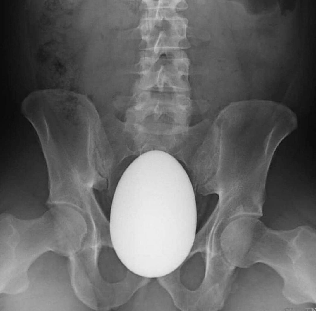 Everyday life of physicians - Surgery, X-ray, Foreign body, Eggs, Anus