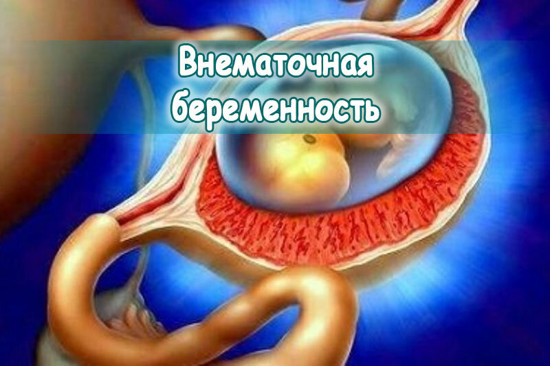 Внематочная беременность | Пикабу