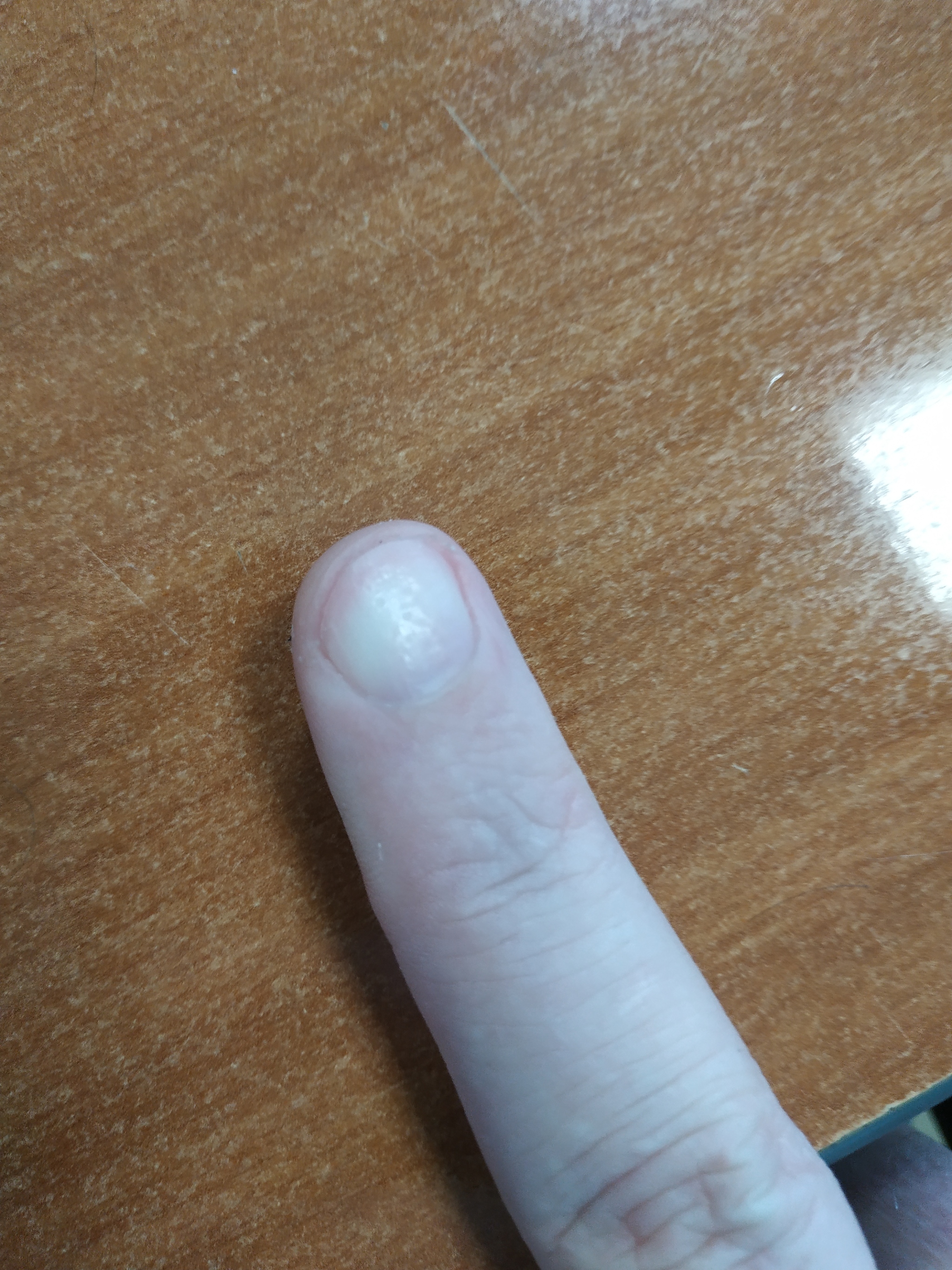 Strange nail, what's wrong with it? - My, Health, Nails, Longpost