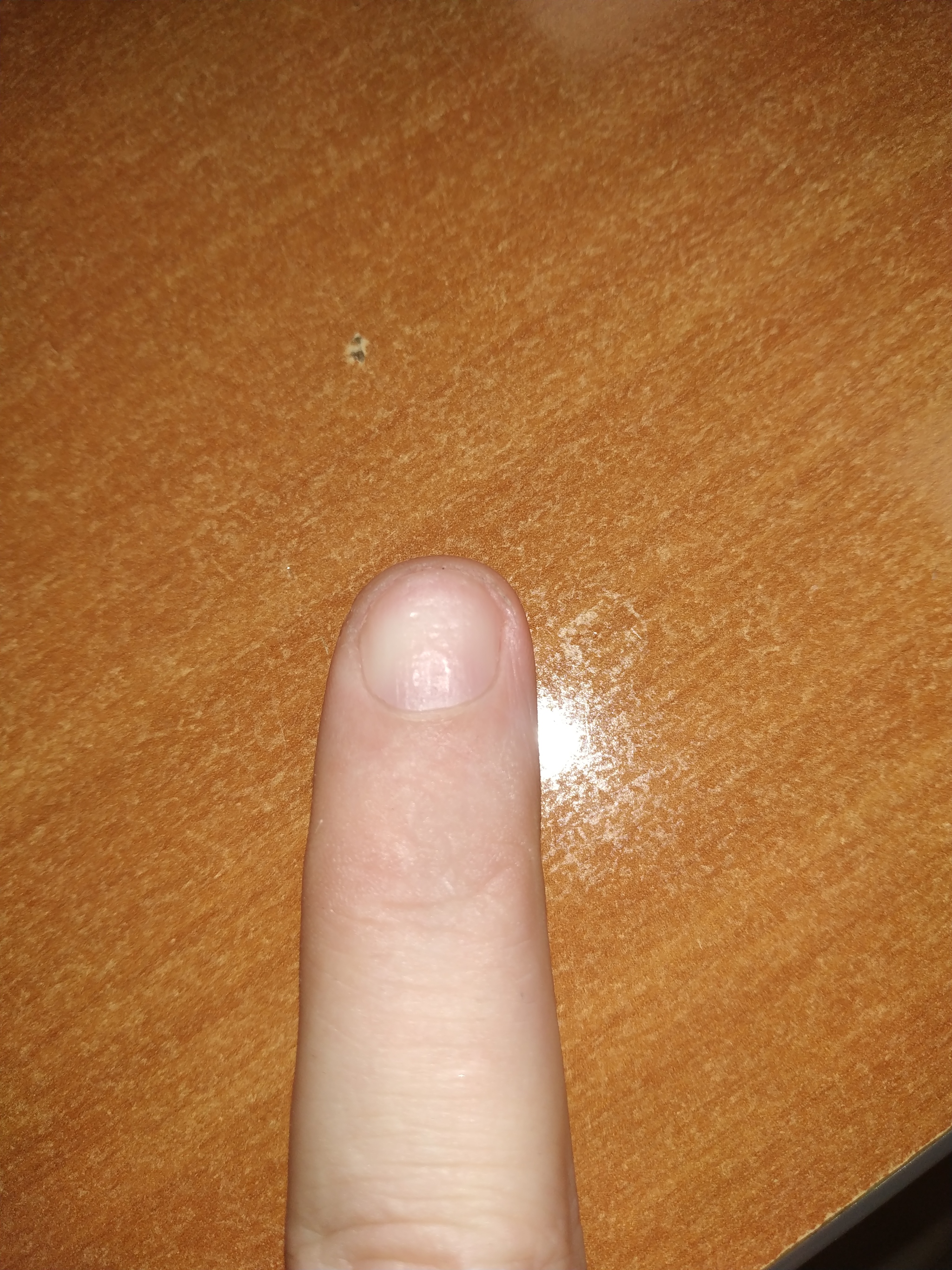 Strange nail, what's wrong with it? - My, Health, Nails, Longpost