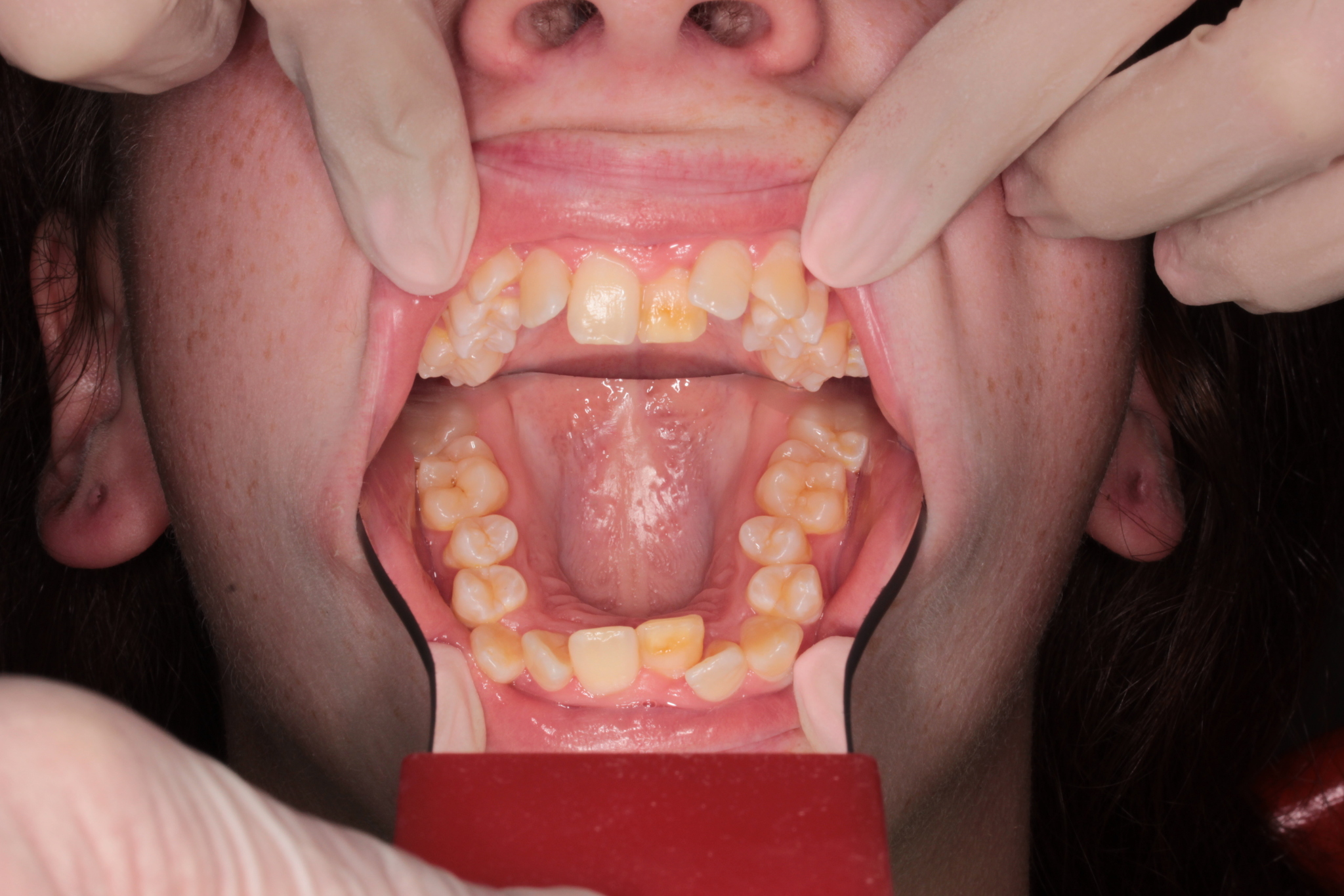 Orthodontics. Result in 2 years. Before and after - My, Braces, Orthodontics, Dentistry, It Was-It Was, Longpost, Teeth