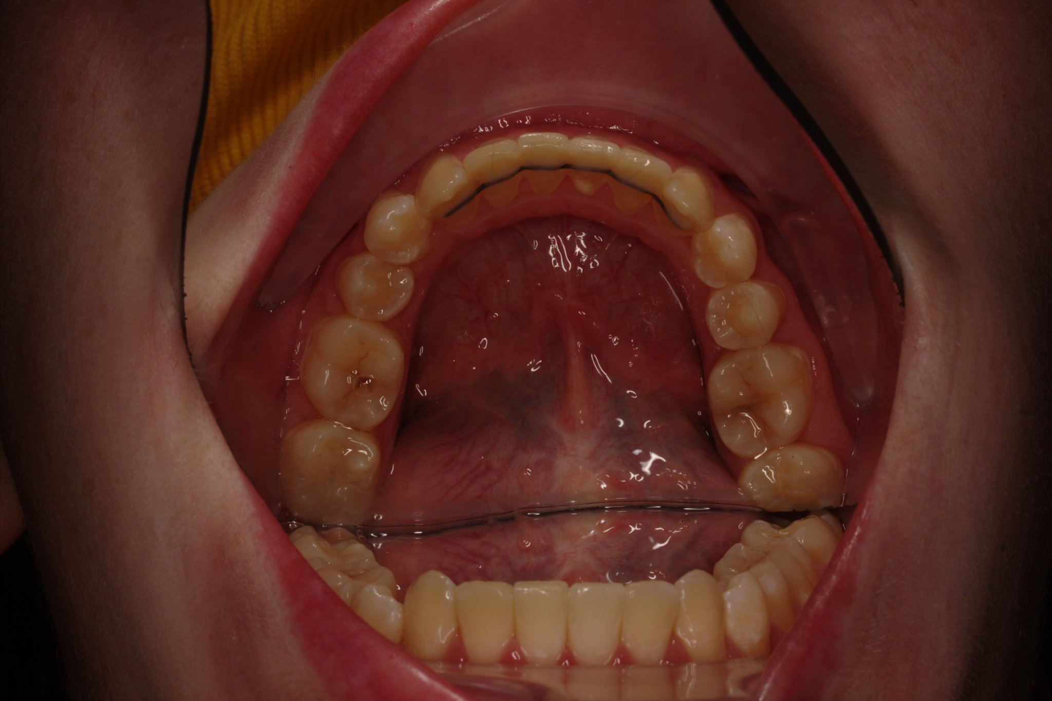 Orthodontics. Result in 2 years. Before and after - My, Braces, Orthodontics, Dentistry, It Was-It Was, Longpost, Teeth