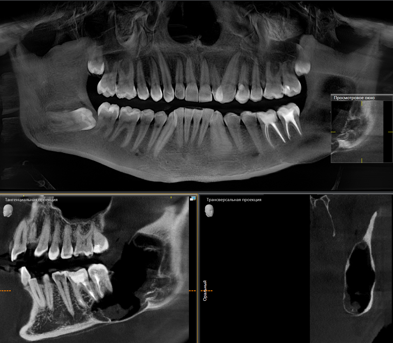 Consequences of untimely removal of wisdom teeth. - My, Dentist, Dentistry, Surgeon, Surgery, Cyst, Doctors, The medicine, Wisdom tooth, Longpost, , Extraction of teeth