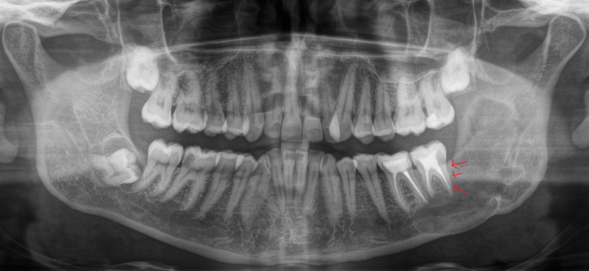 Consequences of untimely removal of wisdom teeth. - My, Dentist, Dentistry, Surgeon, Surgery, Cyst, Doctors, The medicine, Wisdom tooth, Longpost, , Extraction of teeth