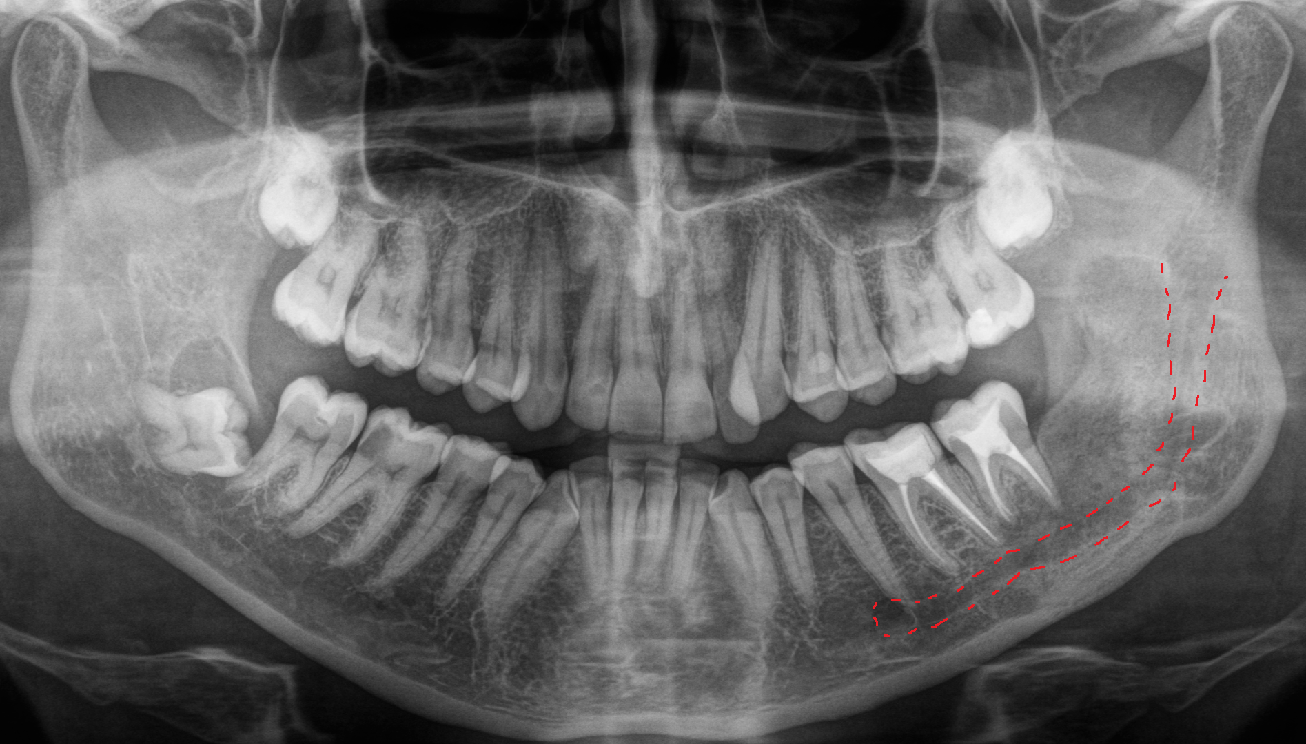 Consequences of untimely removal of wisdom teeth. - My, Dentist, Dentistry, Surgeon, Surgery, Cyst, Doctors, The medicine, Wisdom tooth, Longpost, , Extraction of teeth