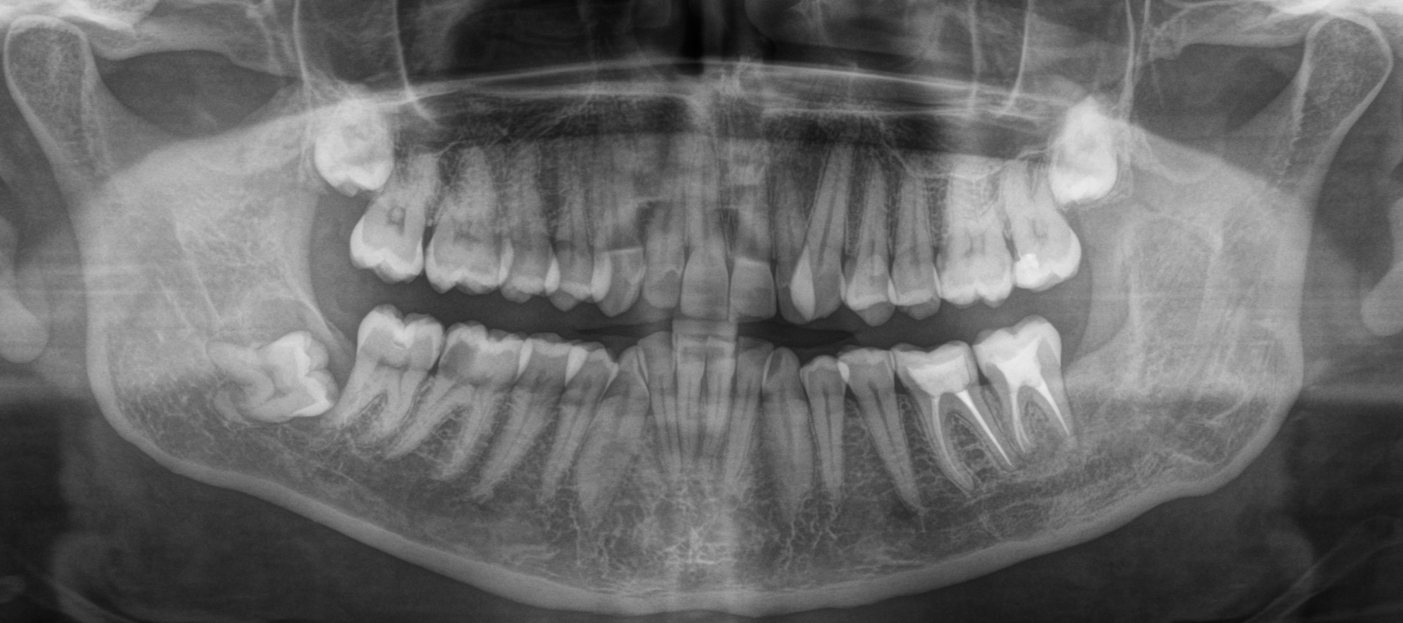 Consequences of untimely removal of wisdom teeth. - My, Dentist, Dentistry, Surgeon, Surgery, Cyst, Doctors, The medicine, Wisdom tooth, Longpost, , Extraction of teeth