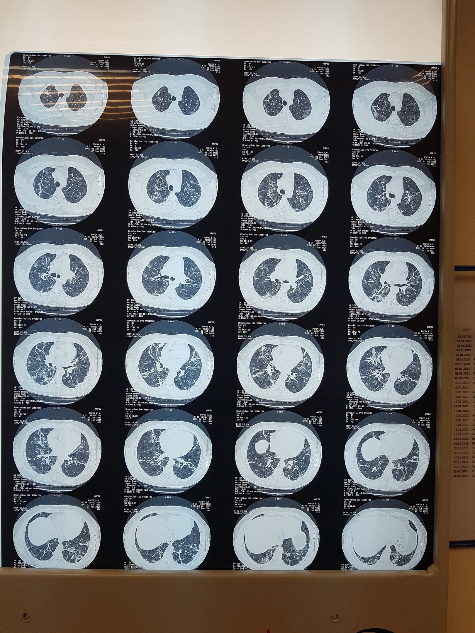 A look at both sides of the coronavirus infection or thinking about a vaccine - My, Coronavirus, Vaccination, Epidemic, Doctors, Longpost