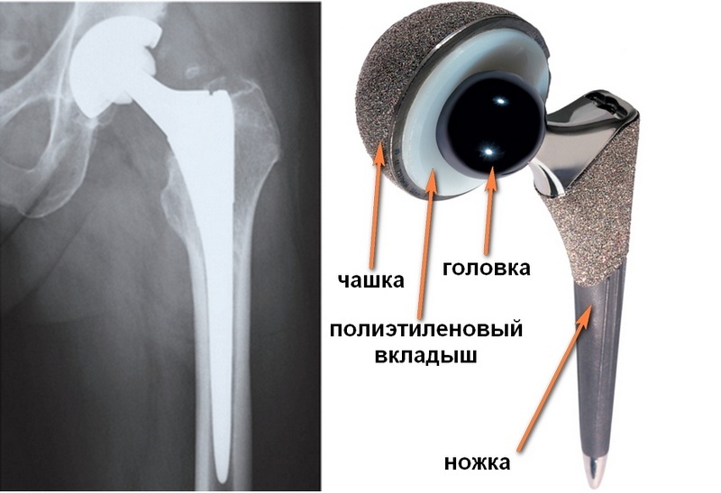 Endoprostheses of the hip joint. - My, Text, Longpost, Endoprosthetics, Overview, The medicine, Hip bone