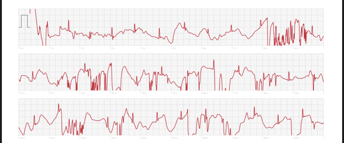 Electric shock and Apple Watch - My, ECG, Apple Watch, Longpost