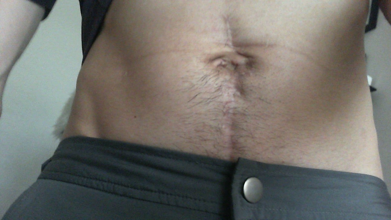 The appendix that burst - My, Appendicitis, Scar, Peritonitis, Navel, Burst, Stomach, Appendix