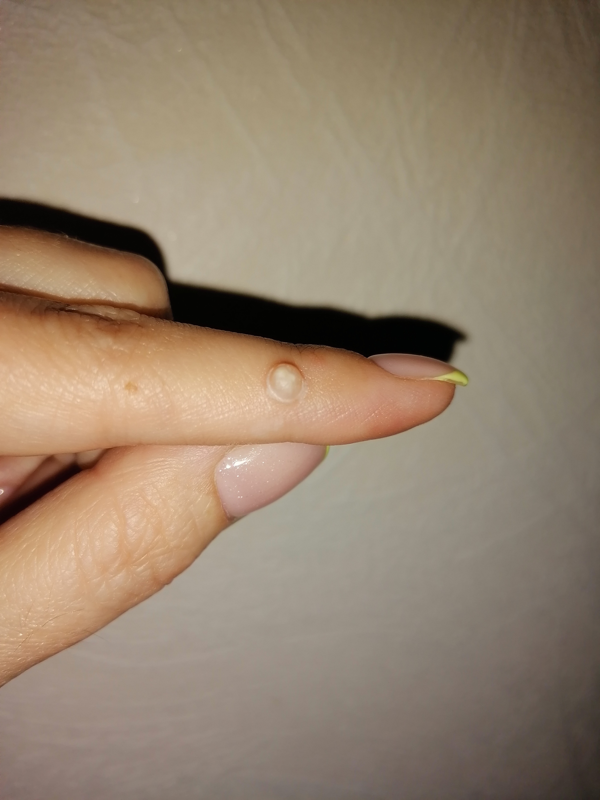 Common wart removal experiment - My, Health, Warts, Longpost