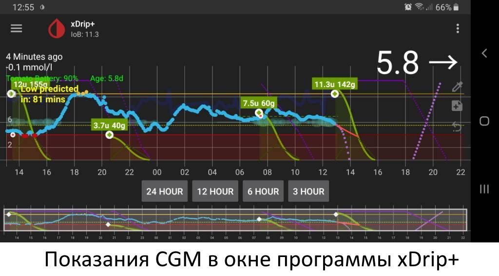 Type 1 diabetes today - My, Diabetes, Type 1 diabetes mellitus, Longpost