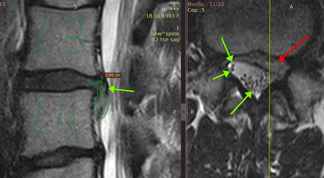 Полностью вылечили грыжу диска L3-L4. Детальный разбор МРТ от невролога для пациентов - Моё, Грыжа, Медицина, Здоровье, Поясница, Боль, Видео, Длиннопост