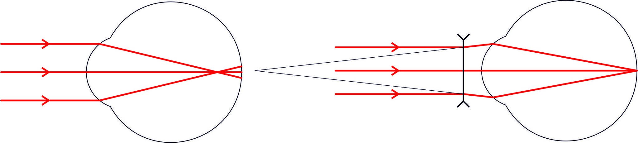 The limits of good vision. - My, Vision, Poor eyesight, Glasses, Contact lenses, Spectacle lenses, Night lenses, Lenses, Keratoconus, , Eyes, Longpost