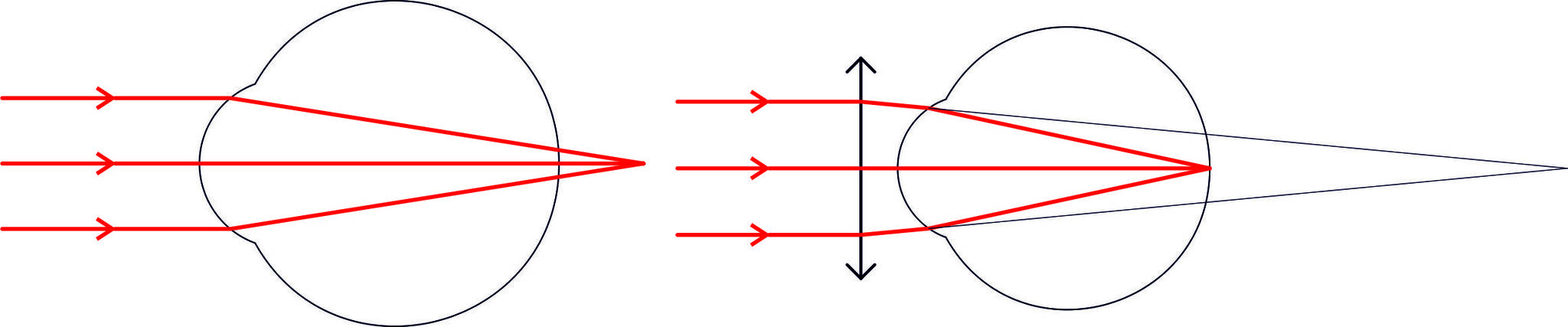 The limits of good vision. - My, Vision, Poor eyesight, Glasses, Contact lenses, Spectacle lenses, Night lenses, Lenses, Keratoconus, , Eyes, Longpost