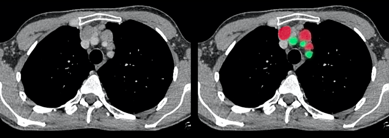 Diagnosis of cancer at an early stage. - My, Oncology, Surgery, Coronavirus, The medicine, Radiology, CT, Longpost