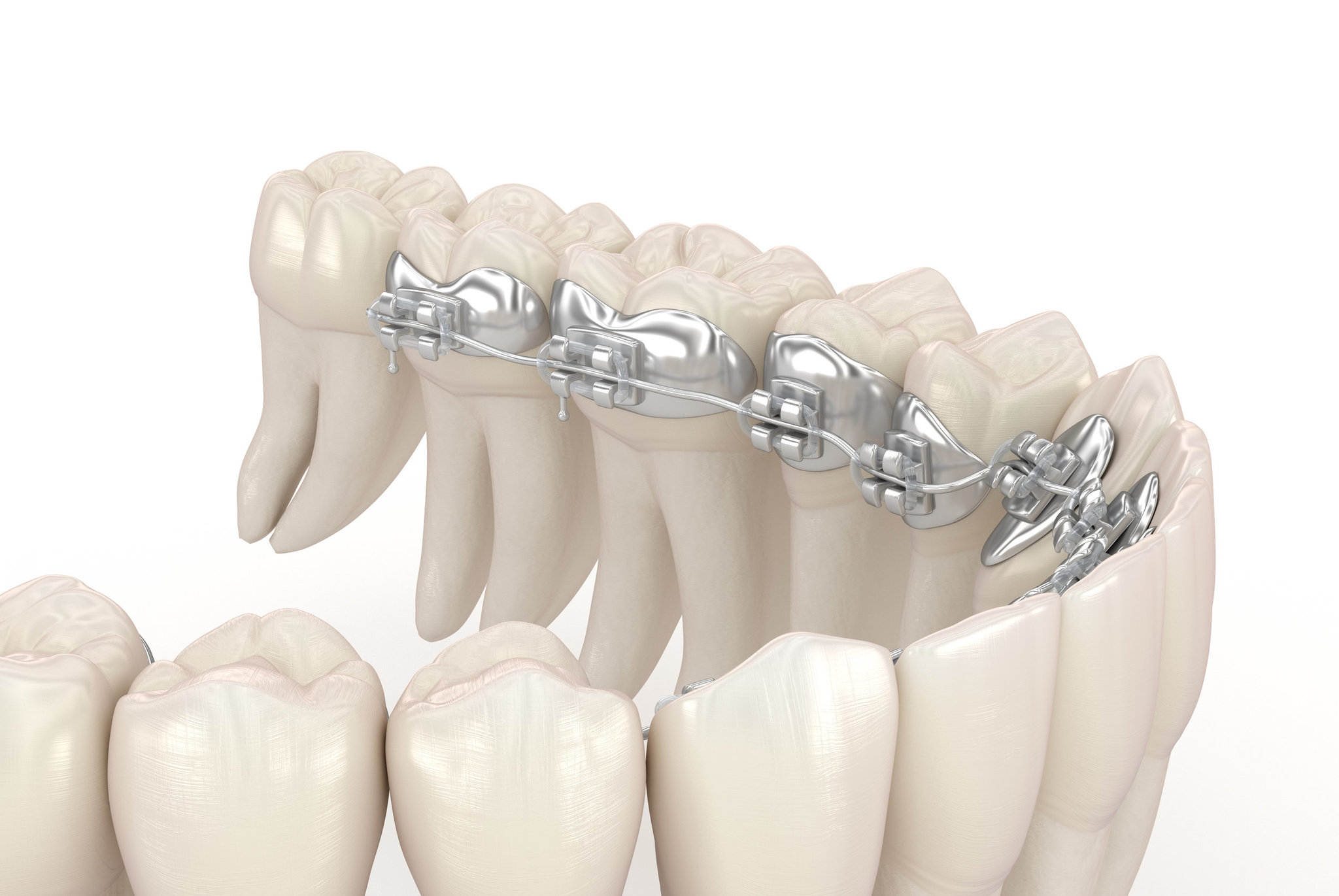 Why are braces so expensive? - My, Braces, Orthodontics, Bite correction, Dentistry, The medicine, Health, beauty, Doctors, , Doctors need help, Teeth, Moscow, Treatment, Interesting, Russia, Technologies