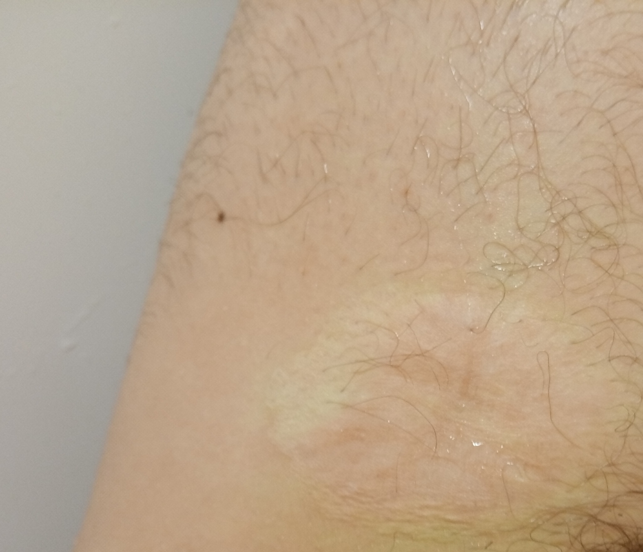 This is what the bite mark of the Arctic Vzgmyzy looks like - My, Scar, Bite