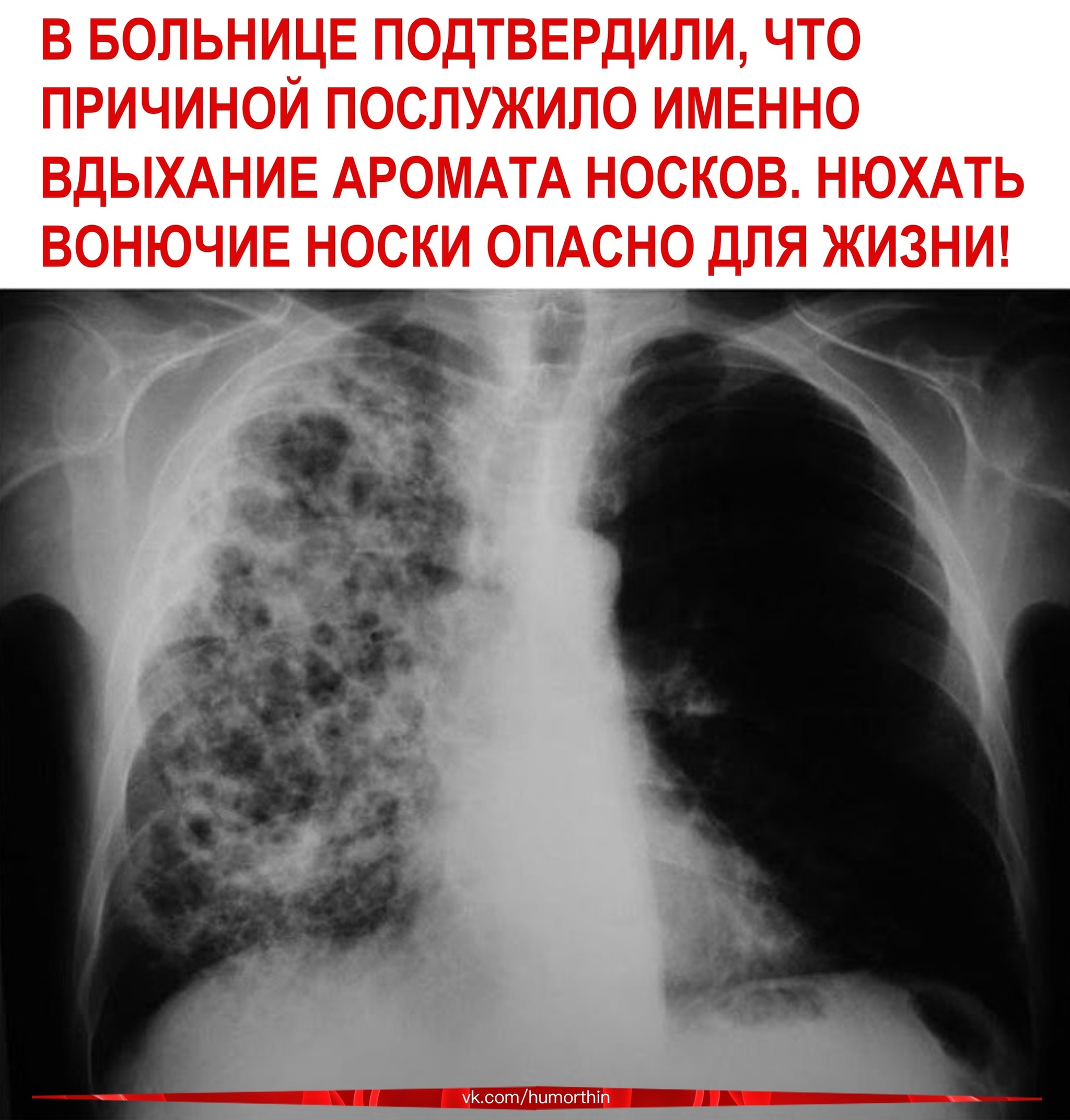Аспергиллезная пневмония