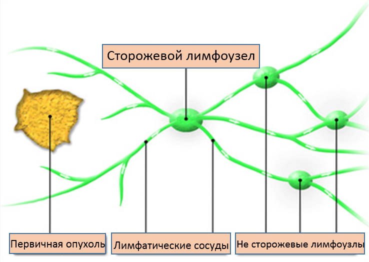 Слоновая болезнь - Медицина, Онкология, Болезнь, Лечение, Длиннопост