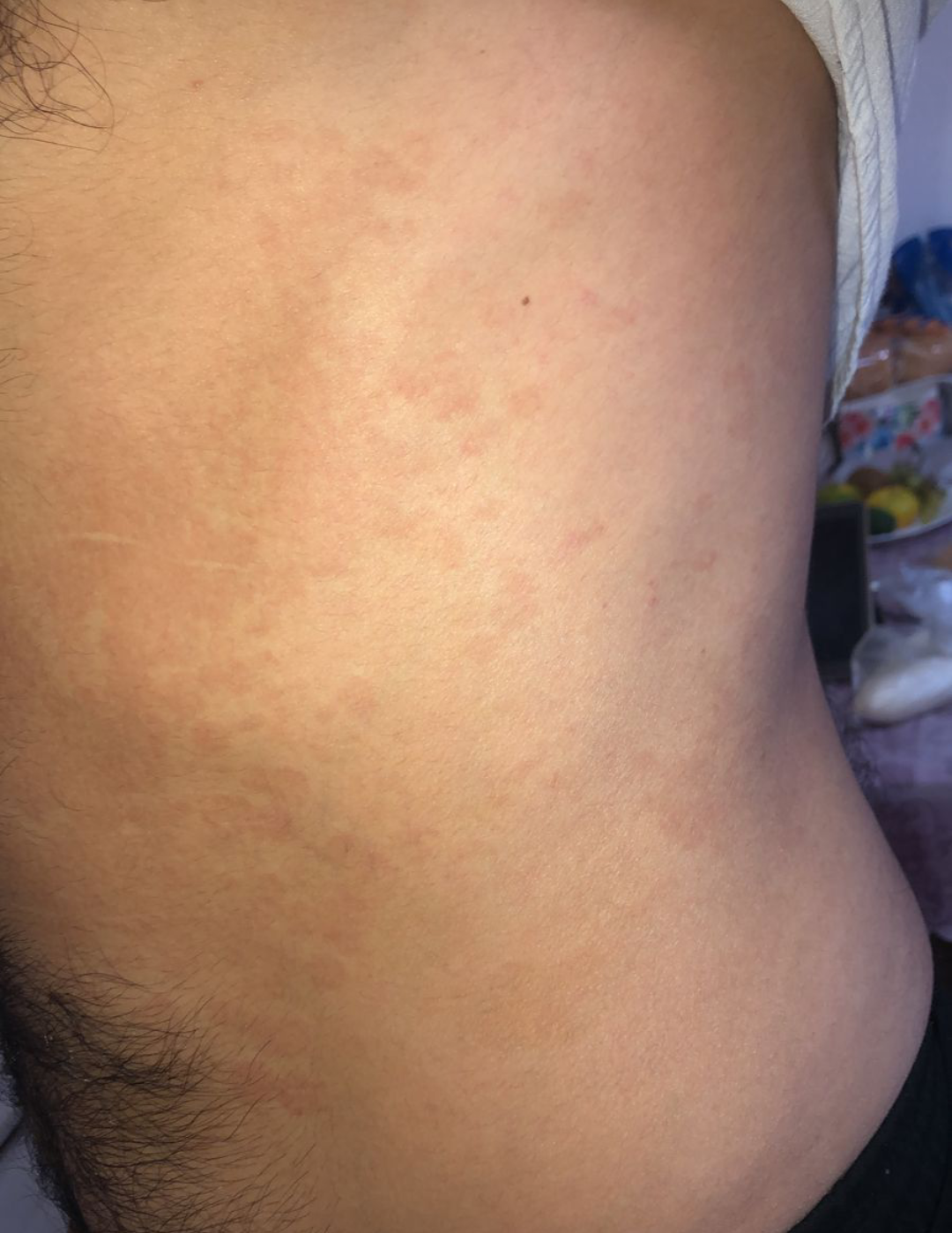 Spots and severe itching 10 years (!!!) after a bee sting - how to help??? - My, The medicine, Dermatology, Allergy, Longpost