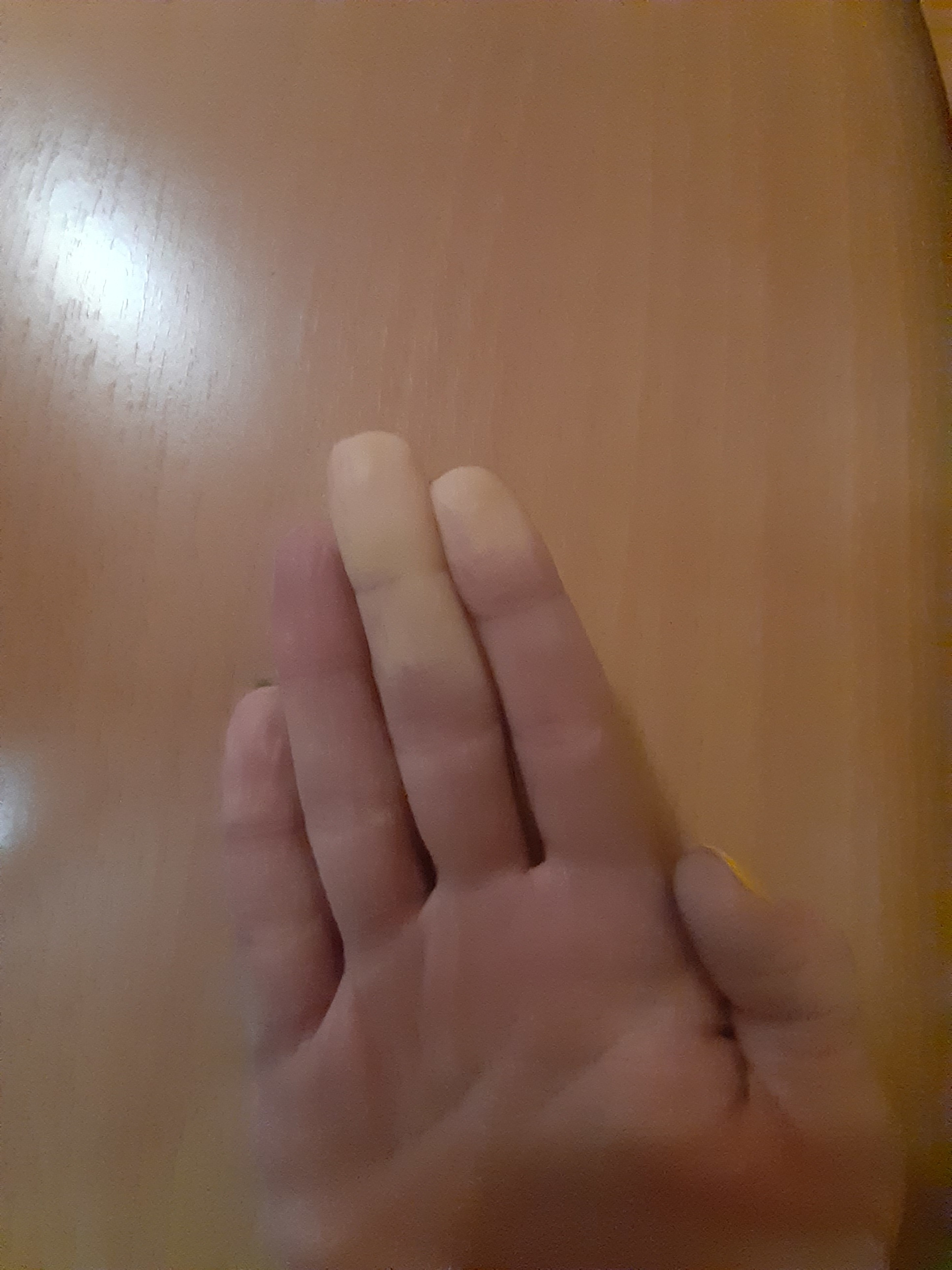 The winter is coming... - My, Raynaud's disease, Cold, The winter is coming, Winter, Disease, Longpost