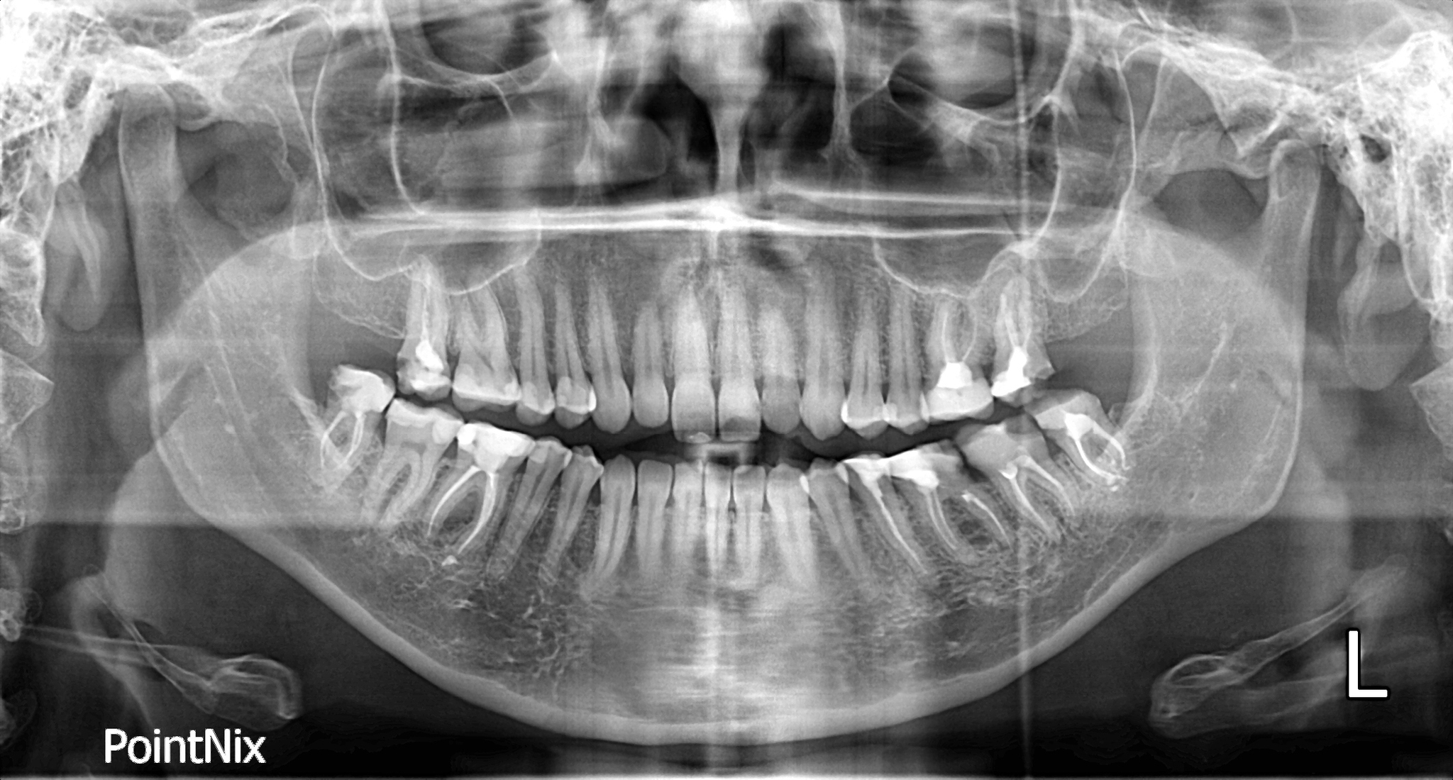 Question on prosthetics in case of chronic injury of one of the CLS - My, Teeth, Bite correction, Dental implantation, Orthopedics, Longpost