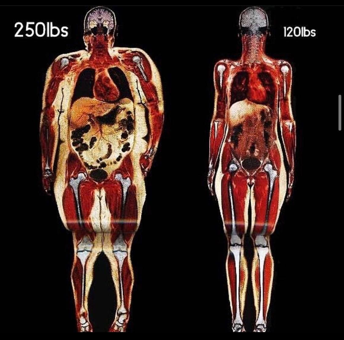 115 kg vs 55 kg - The medicine, Obesity, Illustrations