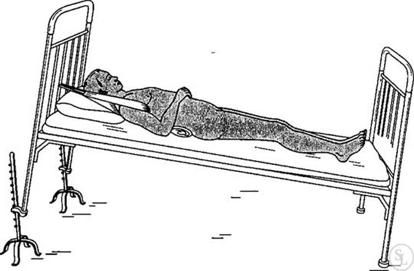 Compression fracture of the spine - how to determine its presence? - My, Health, Disease, Operation, Spine, Fracture of the spine