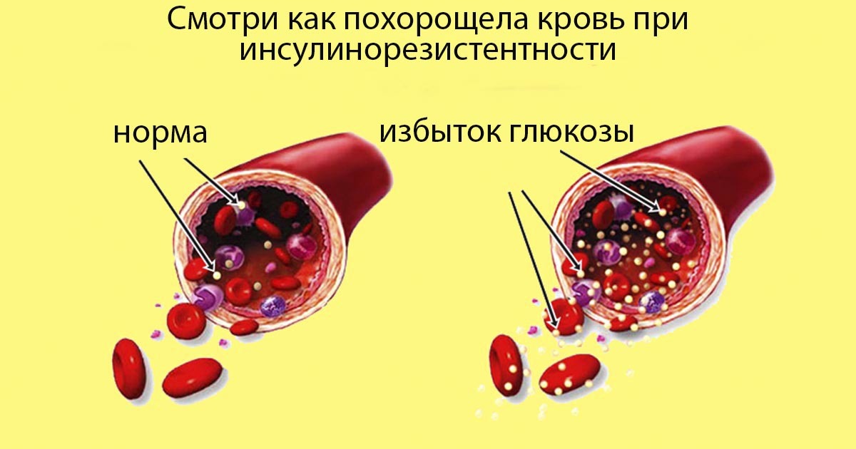 Первые симптомы повышенного сахара