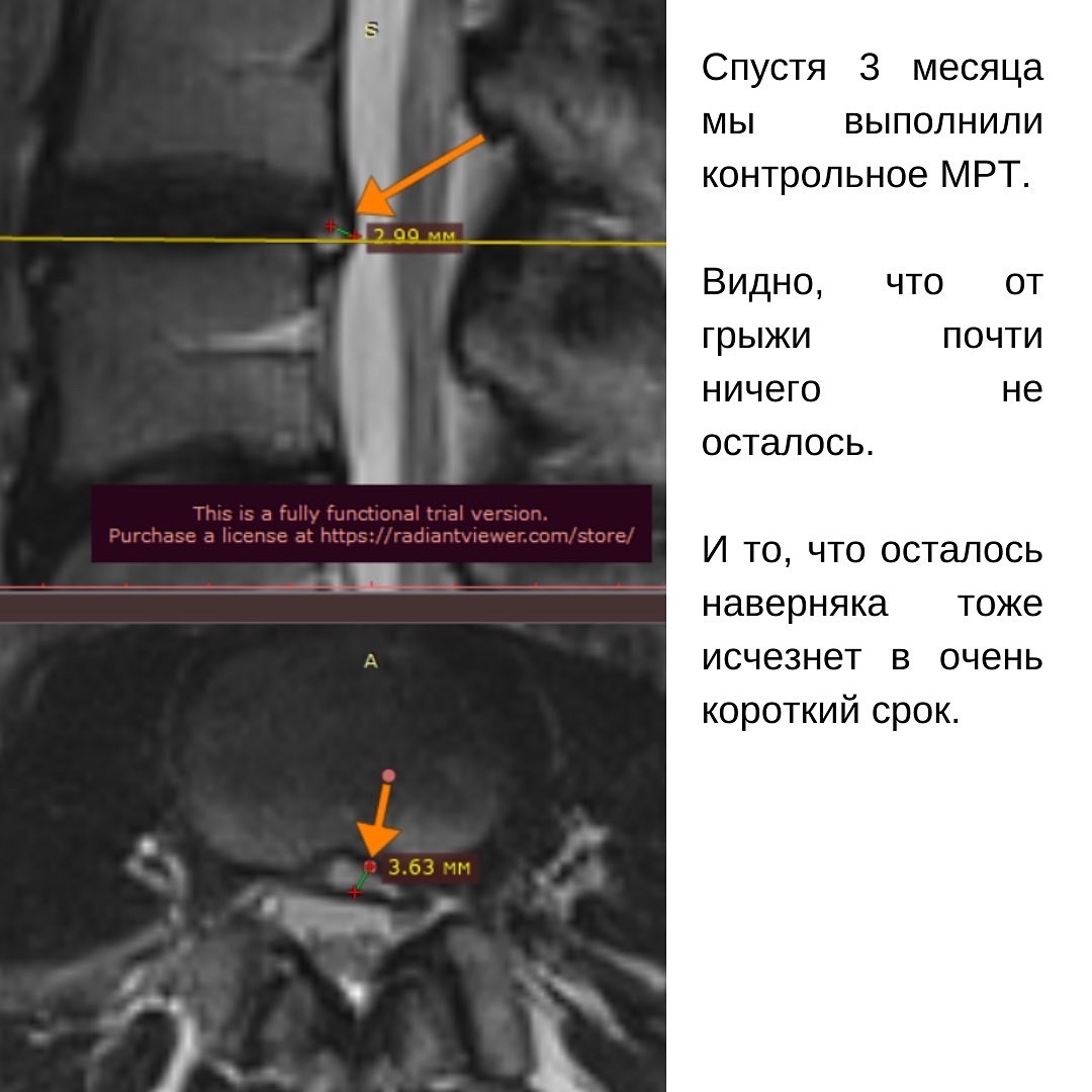 Повторная грыжа позвоночника. Может ли грыжа уменьшиться в размерах. Секвестрированная грыжа форум. На повторном мрт грыжа уменьшилась.