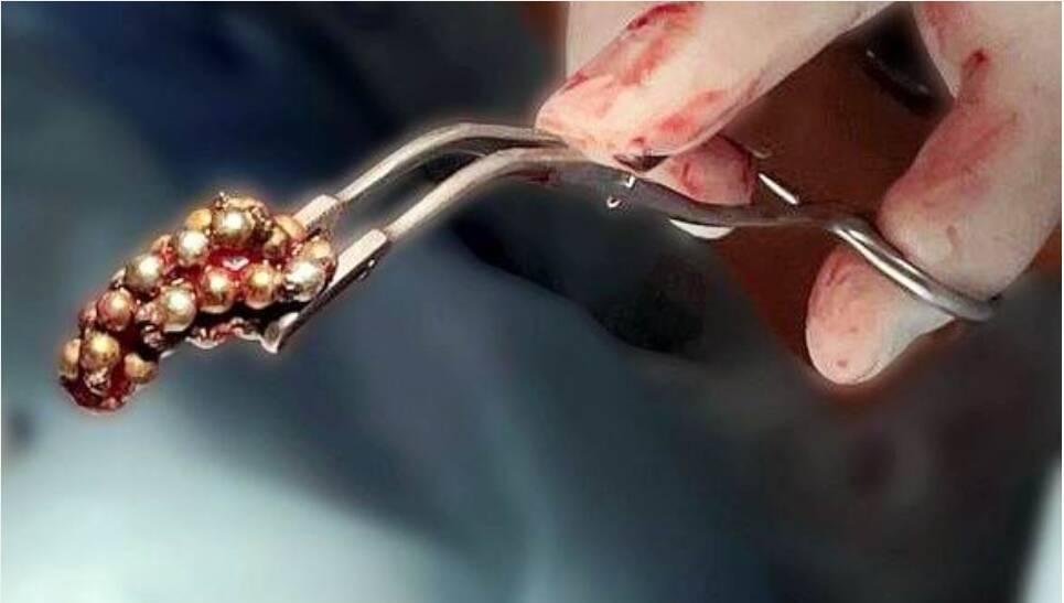 Two teenagers in Volyn stuffed magnetic balls into their urethra to enhance sensations during masturbation - Negative, Volyn, Teenagers, Surgery, balls, Text, Longpost