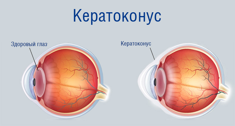 Vision Correction Part 6 - Keratoconus - My, Vision, Operation, Keratoconus, Longpost