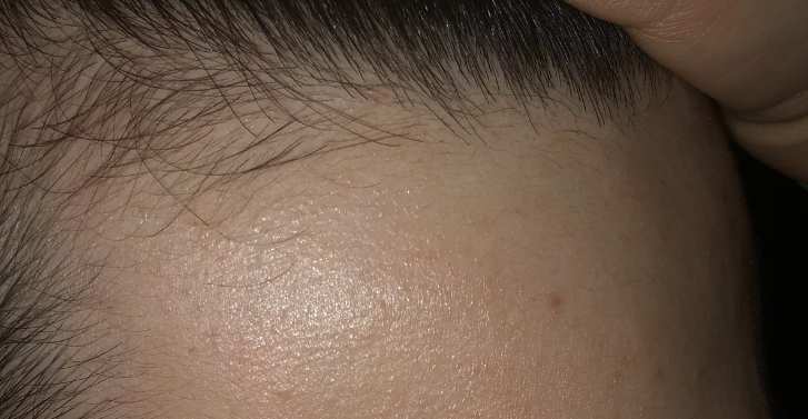 Baldness in 18 - Health, Trichologist, Hair, Help